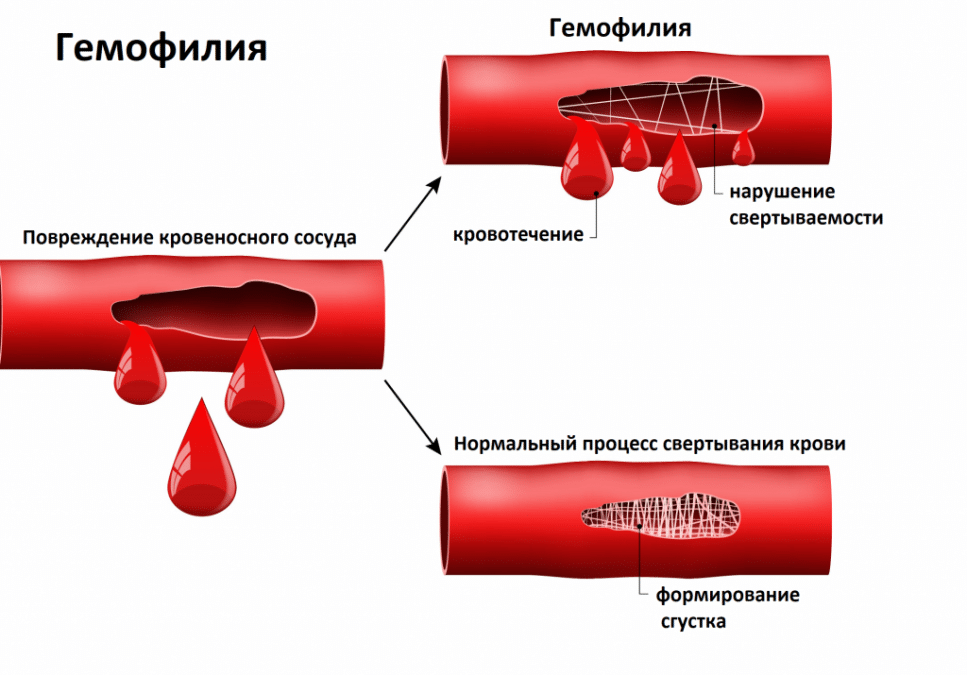 Как бороться с атеросклерозом